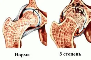 чи можна вилікувати артроз тазостегнового суглоба