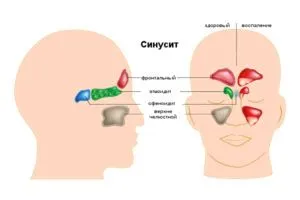 фронтит і як його лікувати