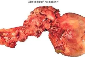 болить шлунок алкоголь робити підшлункова залоза запустити п'янка виразка можна відновити коліт голодний пиво розлад вплив ФГС тяжкість вино