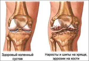як лікувати суглоби ніг народними засобами