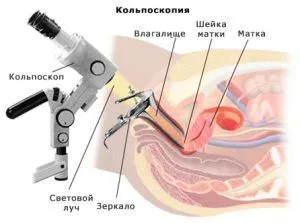 як вилікувати кісту на шийки матки