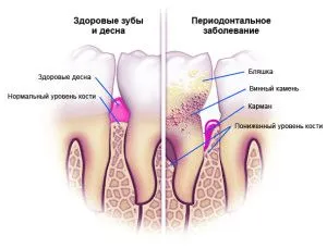 лікувати ясна після видалення зуба