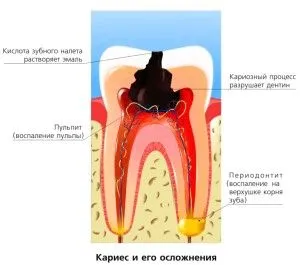 стоматит лікування в домашніх умовах