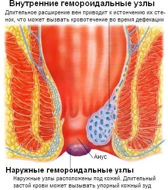 вилікувати геморой