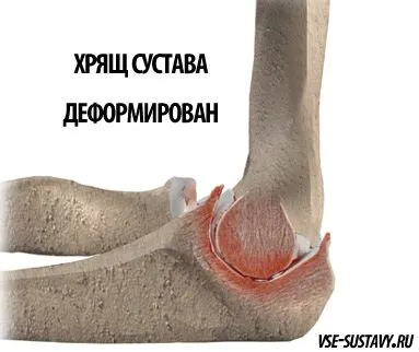 як лікувати суглоби ліктів