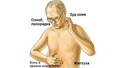 жовтяниця причина симптом лікування
