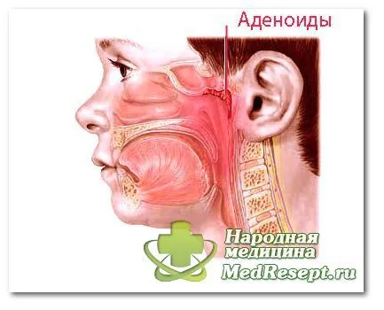 Як лікувати дитячі аденоїди аденоїдит у дітей