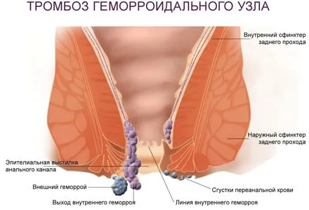 як вилікувати гострий геморой