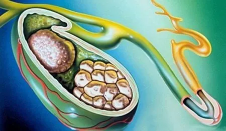 як лікувати холецистит