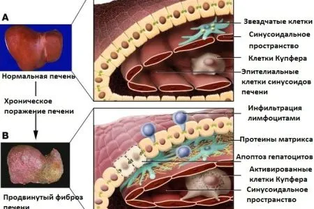 як лікувати фіброз печінки