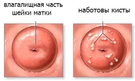 як вилікувати кісту на шийки матки