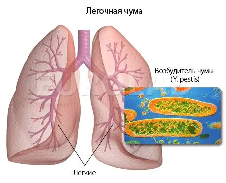 як лікувати легеневу чуму