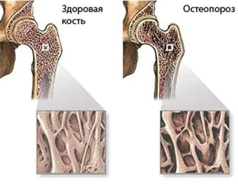 якщо не лікувати остеопороз