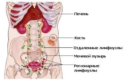 як вилікувати рак якщо пішли метастази