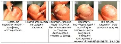 Як вилікувати нігті від грибка на руках в домашніх умовах - все про грибок як вилікувати нігті на руках в домашніх умовах
