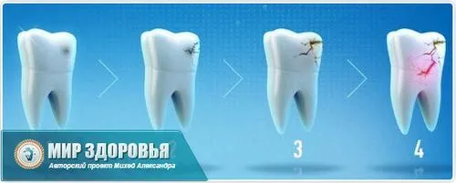 чи можна вилікувати запущений карієс