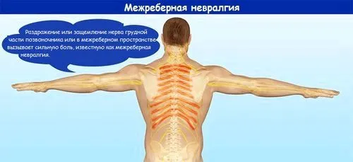 як лікувати міжреберної невралгії в області серця