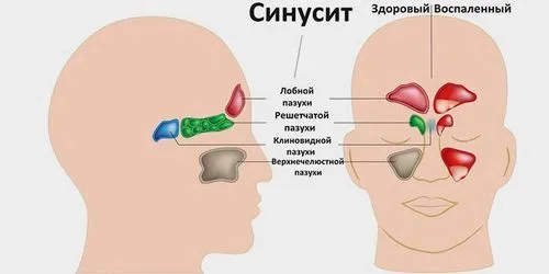 кіста