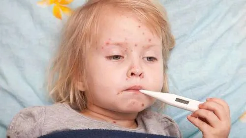 лікувати вітрянку в домашніх умовах