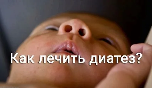 лікувати діатез