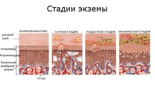 як лікувати грибковий дерматит