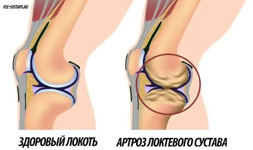 артроз ліктьового суглоба симптоми лікування ступеня причини