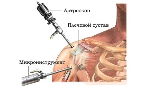 лікувати суглоби плечей