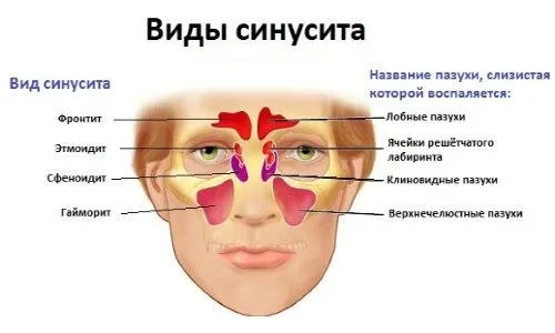 ніж лікувати синусит і риніт
