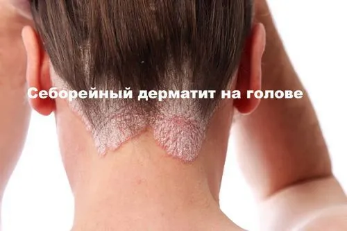 вилікувати себорейний дерматит