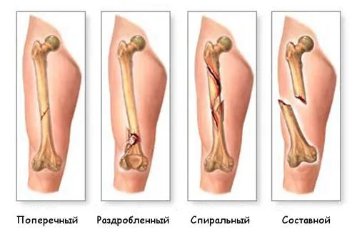 лікувати ногу після перелому