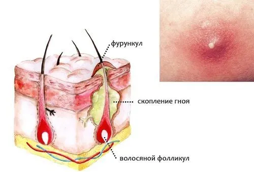 як лікувати фурункул біоптрон