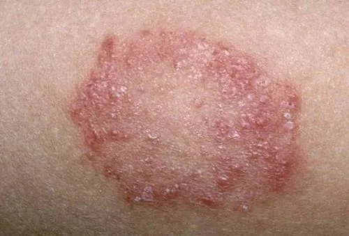 як лікувати грибковий дерматит