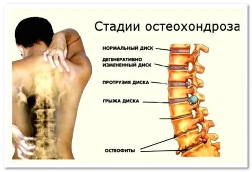 як лікувати міжреберний хондроз
