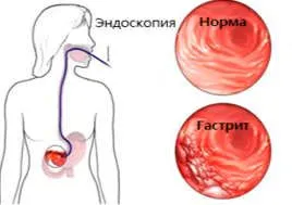 як вилікувати зернистий гастрит