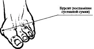 як лікувати запалення суглоба великого пальця ноги