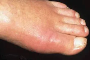 як лікувати запалення суглоба великого пальця ноги
