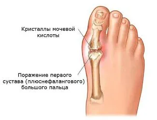 як лікувати запалення суглоба великого пальця ноги