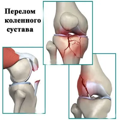 як лікувати забій з пухлиною