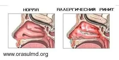 хронічний риніт класифікація