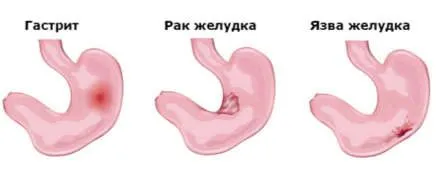 як вилікувати зернистий гастрит