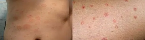 як лікувати псоріаз на ранній стадії