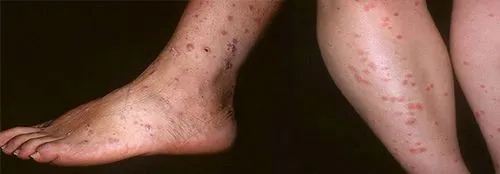 як лікувати псоріаз на ранній стадії