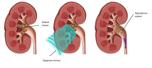 як лікувати нирки самостійно