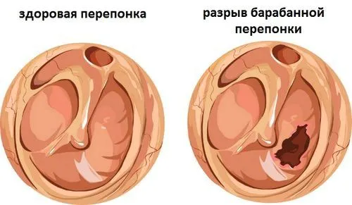 як довго заживає барабанна перетинка після розриву