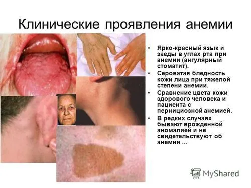 чи потрібно лікувати анемію