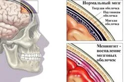 як лікувати шию при застуді