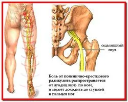 як вилікувати радикуліт травами