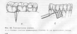 як лікувати кишені в яснах