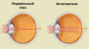 як лікувати вроджений астигматизм