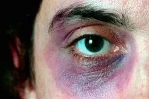 як швидко вилікувати забій губи